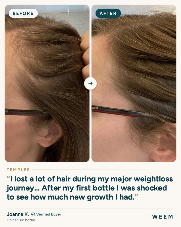 Joanna K., before and after (temples): I lost a lot of hair during my major weightloss journey. After my first bottle I was shocked to see how much new growth I had.