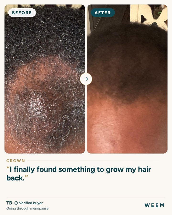 TB, before and after (crown, going through menopause): I finally found something to grow my hair back.
