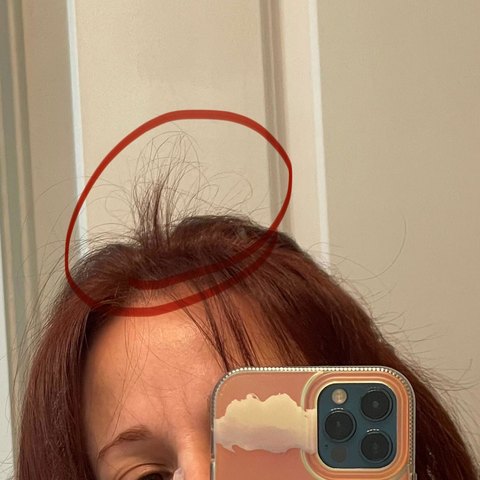 Jessica’s regrown spot at her hairline, circled in her review photo
