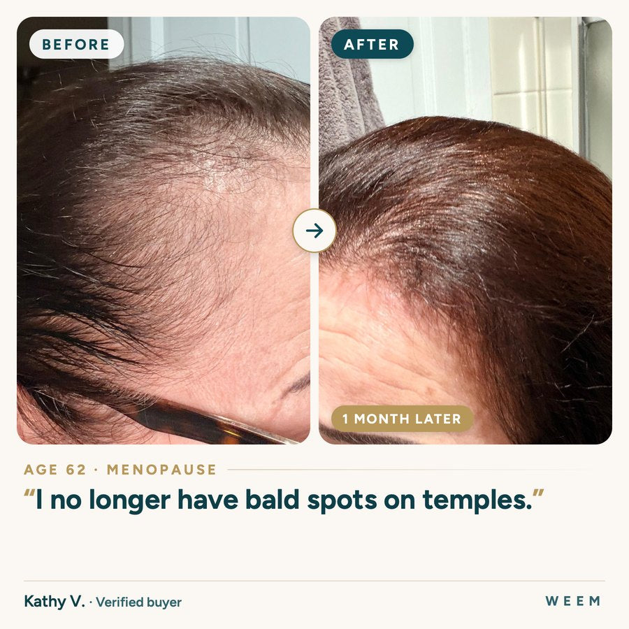 Kathy V., 62, before and after: I no longer have bald spots on temples.
