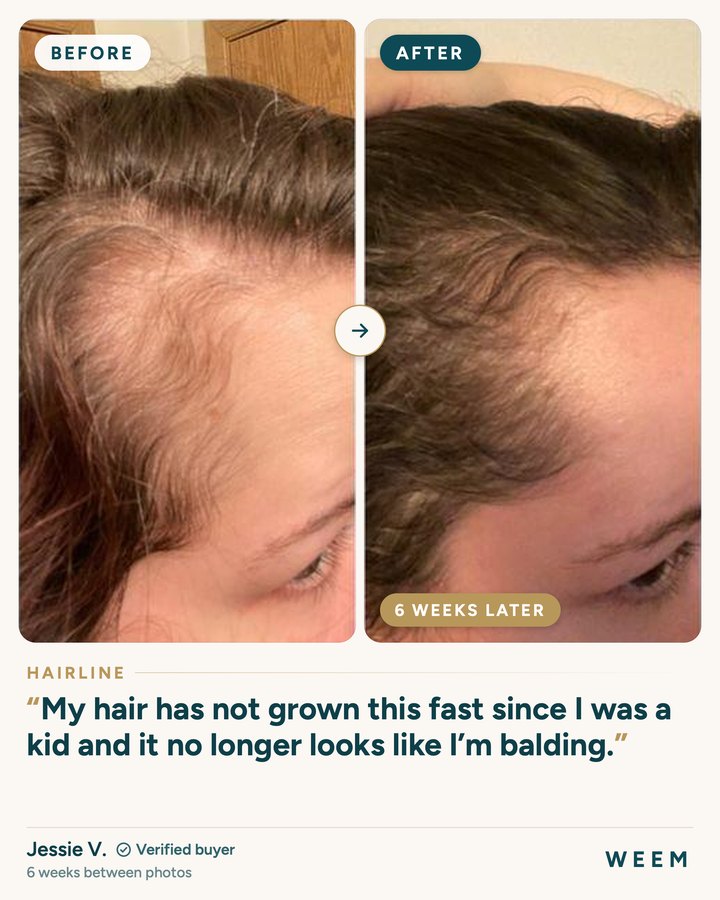Jessie V., before and after (hairline, 6 weeks later): My hair has not grown this fast since I was a kid and it no longer looks like I’m balding.