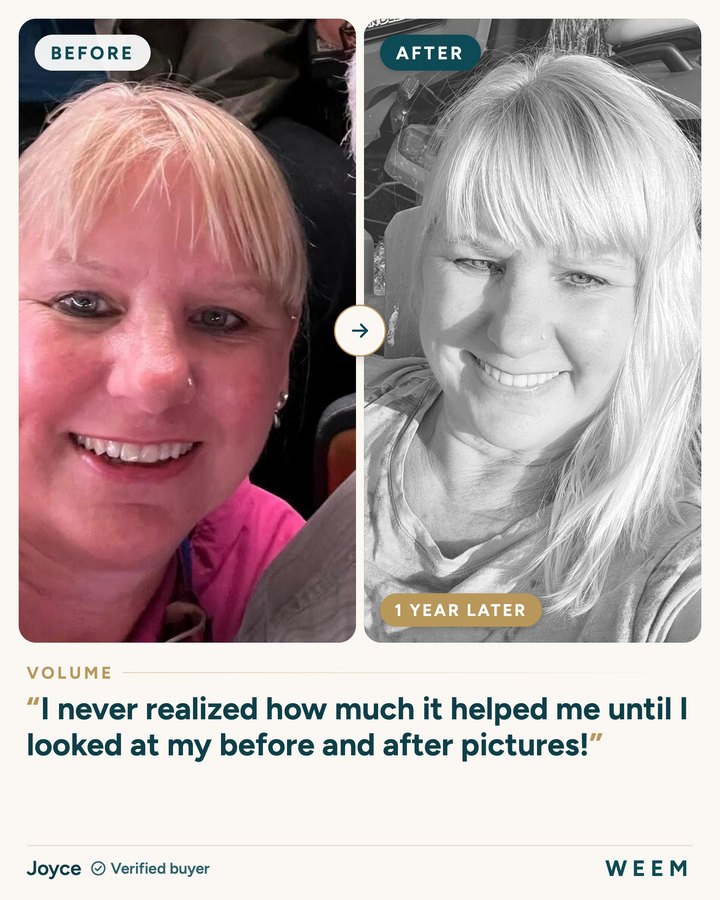 Joyce, before and after (volume, 1 year later): I never realized how much it helped me until I looked at my before and after pictures!