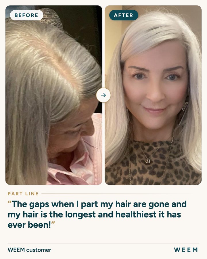 WEEM customer, before and after (part line): The gaps when I part my hair are gone and my hair is the longest and healthiest it has ever been!