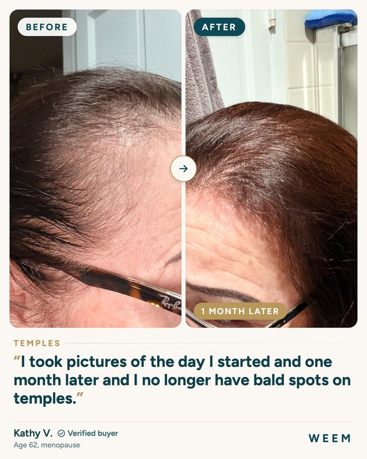 Kathy V., 62, before and after, temples, one month later
