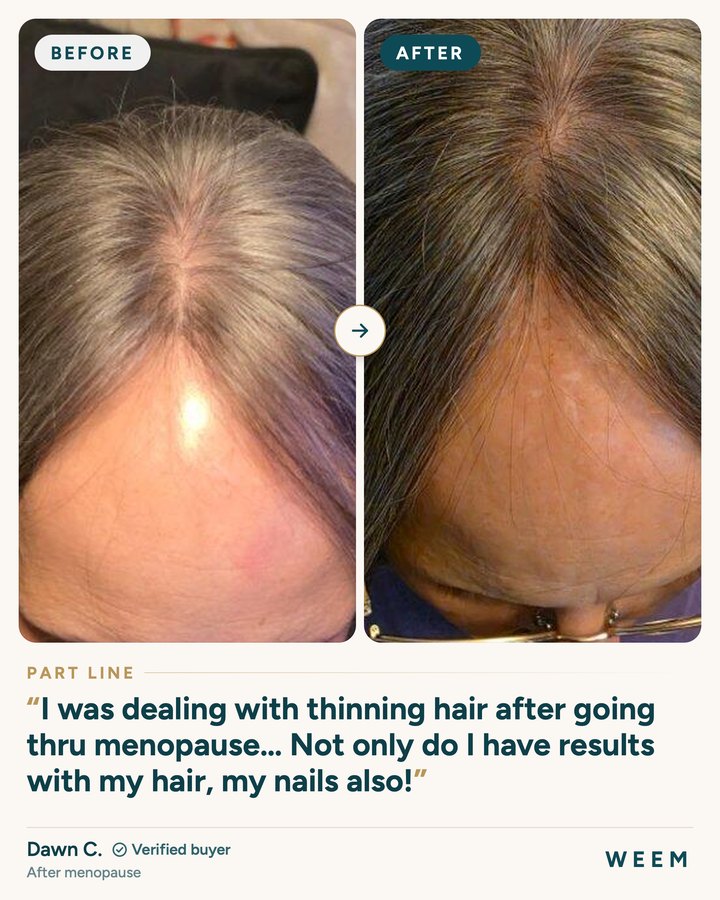 Dawn C., before and after, part line, after menopause