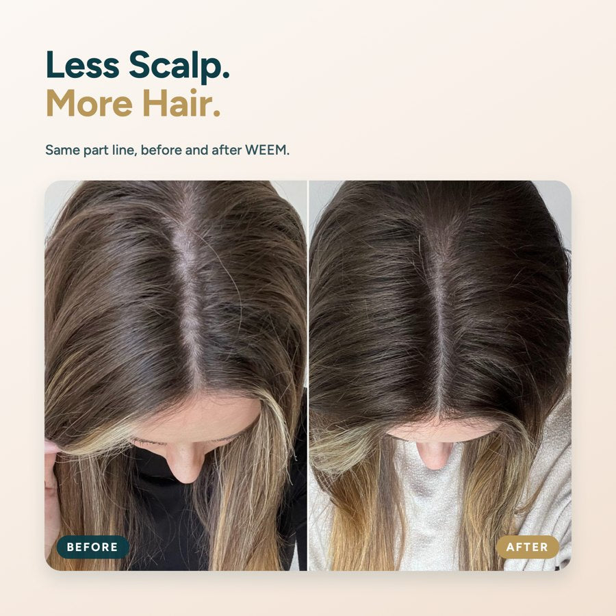 Less scalp, more hair: the same part line before and after WEEM